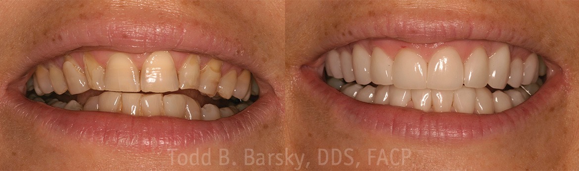 dental crowns before and after dr todd barsky dds in miami