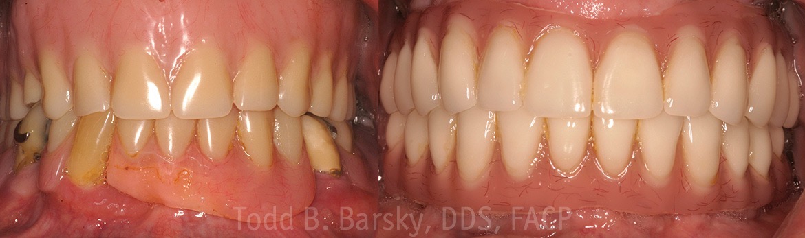 all on 4 dental implants by dr todd barsky dds