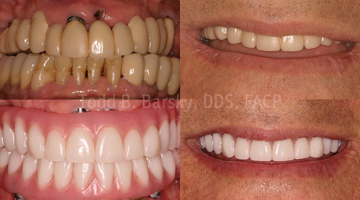 tooth implant before and after