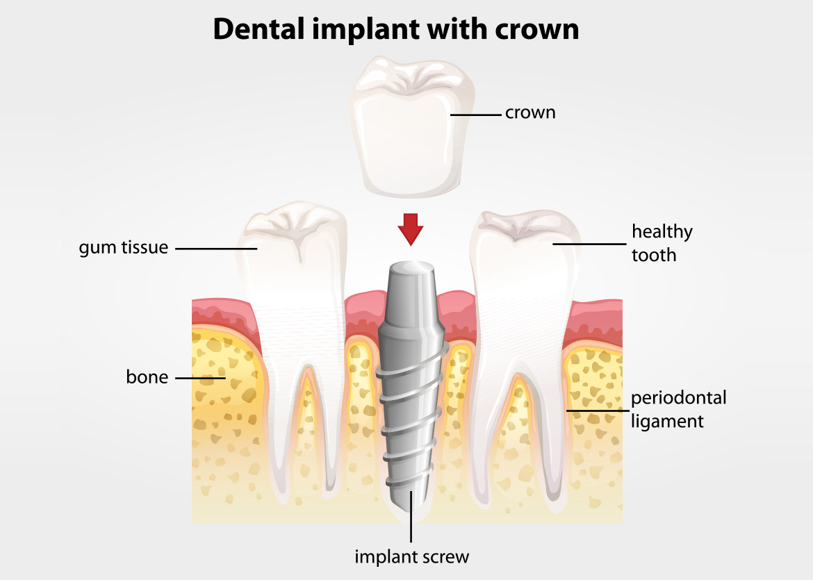 dental crown diagram