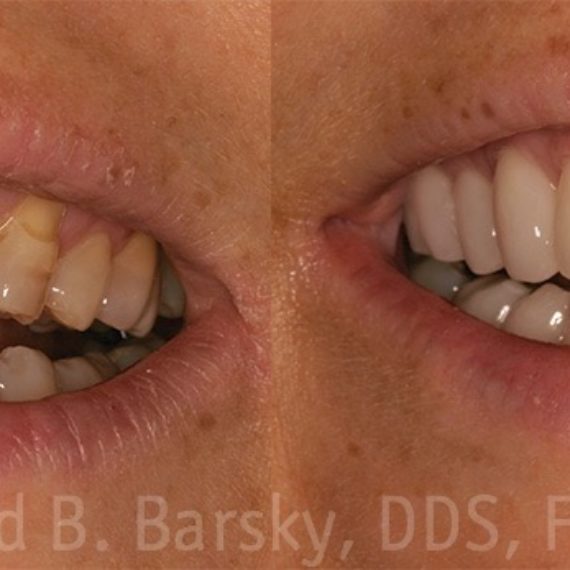dental crowns before and after dr todd barsky dds in miami