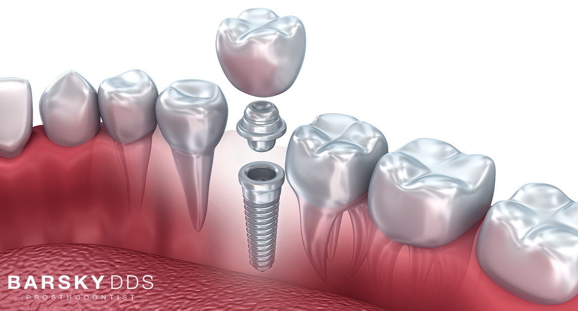 dental implant diagram barsky dds