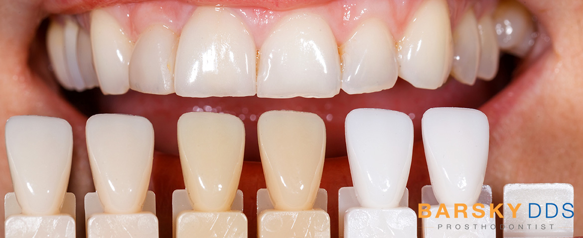 dental veneer color selection barsky dds