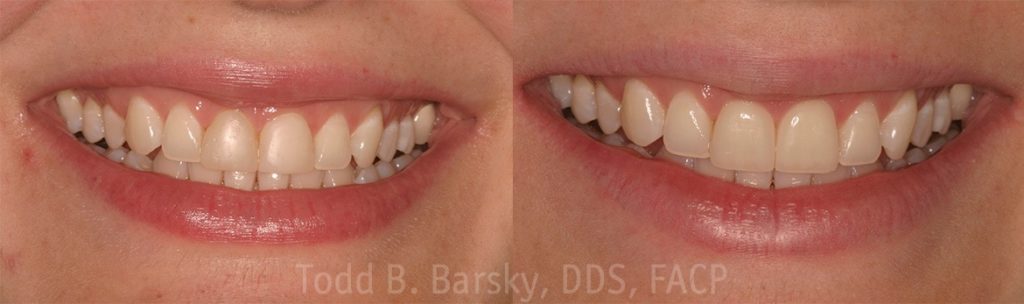 dental-veneers-before-and-after-miami-todd-barsky-dds-facp-1-1170x347