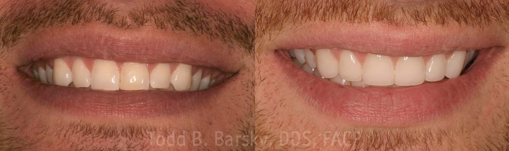dental-veneers-before-and-after-miami-todd-barsky-dds-facp-10-1170x347