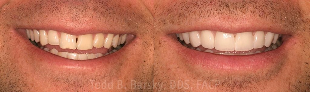 dental-veneers-before-and-after-miami-todd-barsky-dds-facp-11-1170x347