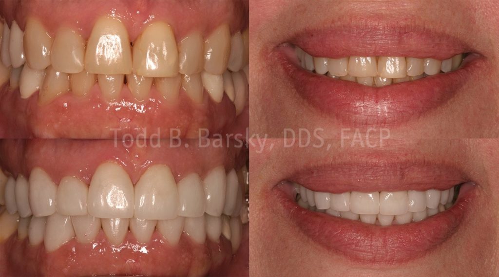 Dental Veneers Before and After by Dr. Todd Barsky