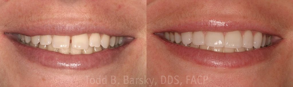 dental-veneers-before-and-after-miami-todd-barsky-dds-facp-14-1170x347