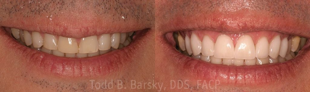 dental-veneers-before-and-after-miami-todd-barsky-dds-facp-20-1170x347