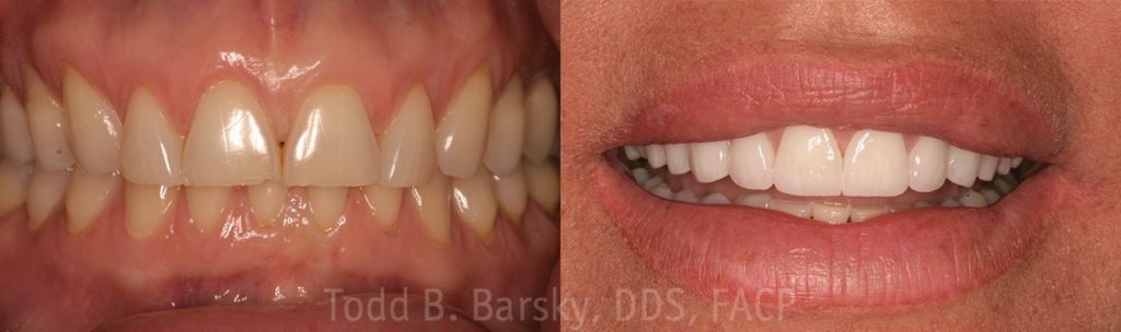 dental-veneers-before-and-after-miami-todd-barsky-dds-facp-22-1170x347