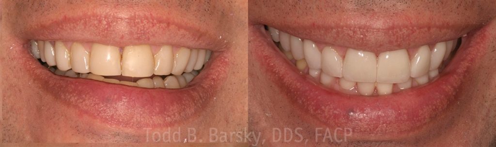dental-veneers-before-and-after-miami-todd-barsky-dds-facp-3-1170x347