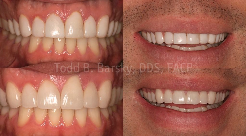 Dental Veneers Archives Todd B. Barsky, DDS