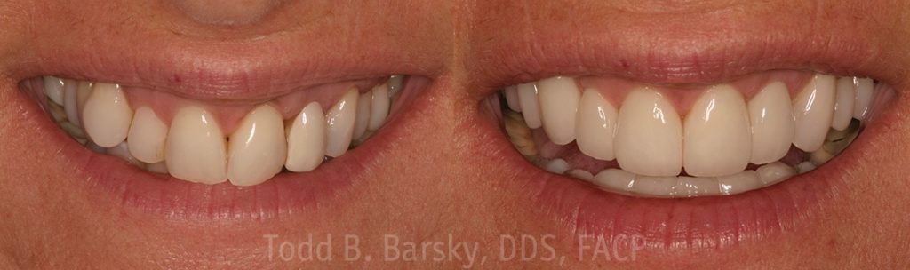 dental-veneers-before-and-after-miami-todd-barsky-dds-facp-6-1170x347
