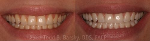 Teeth Whitening Patient