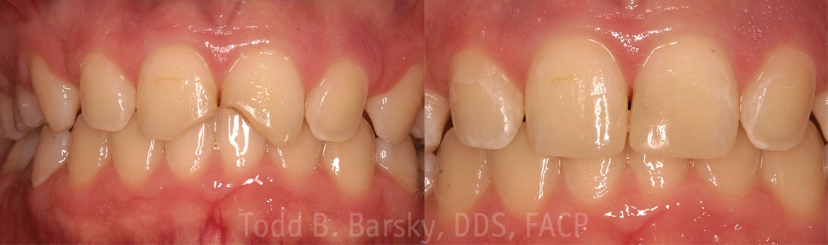 Tooth Bonding by Dr. Barsky