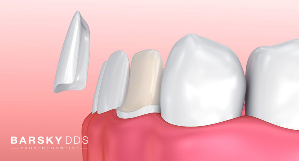 Dental Veneer Placement Example