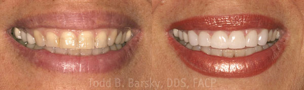 dental veneers before and after by miami todd barsky dds facp