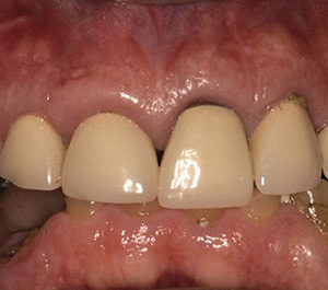 gray line around old crowns, Ask miami prosthodontist todd barsky, dds facp