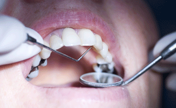 Should you remove your silver fillings? Ask miami prothodontist todd barsky, dds facp