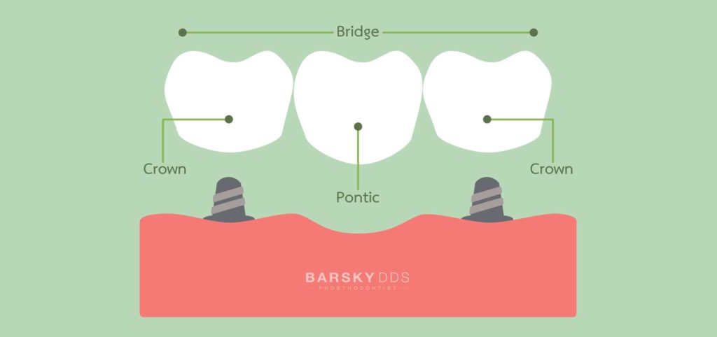 Tooth Gap Bridged with dental Implants