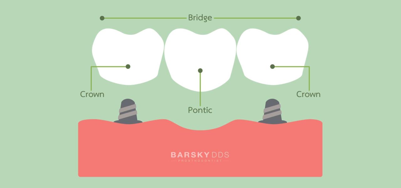 A Guide to Dental Bridge Costs & What is Included Barsky DDS