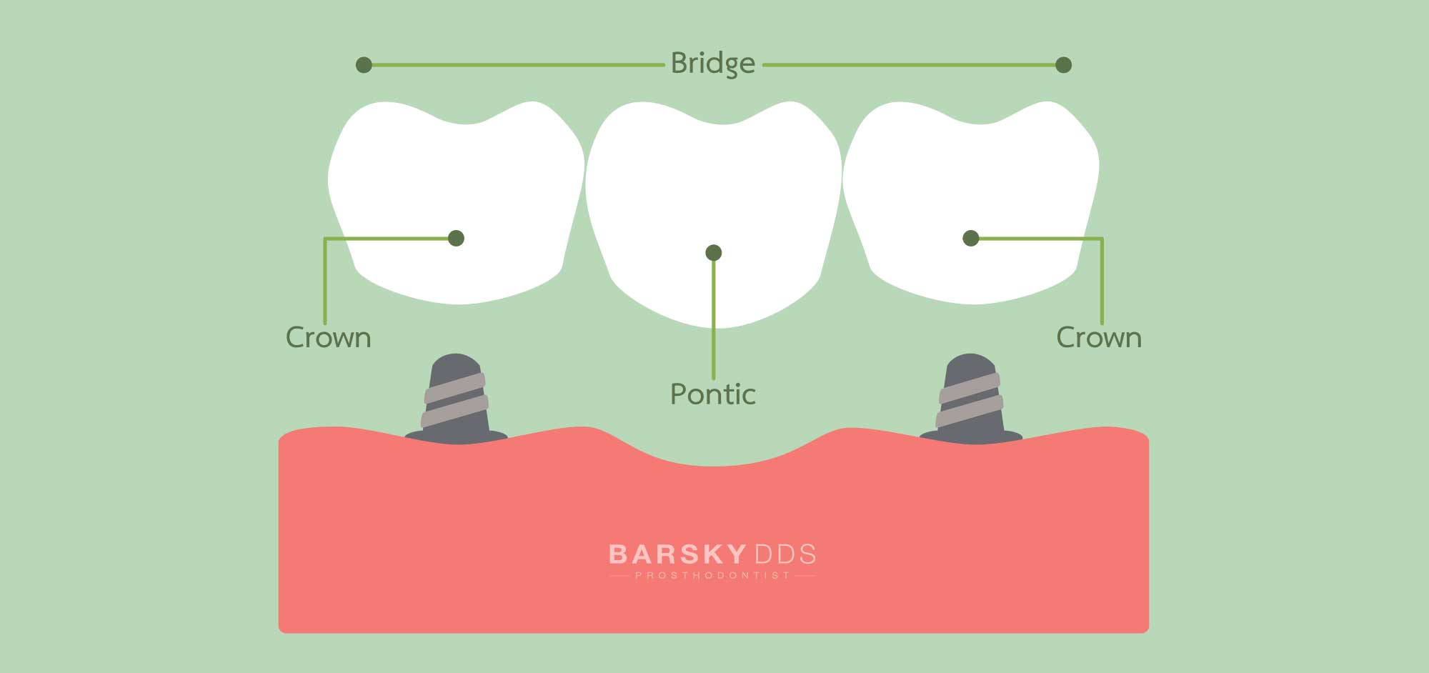 dental bridge parts