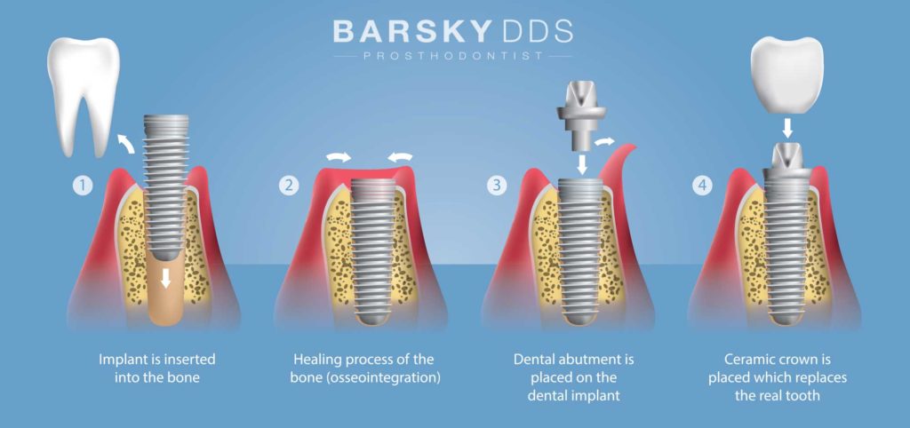 Tooth Crown and Implant Process Diagram