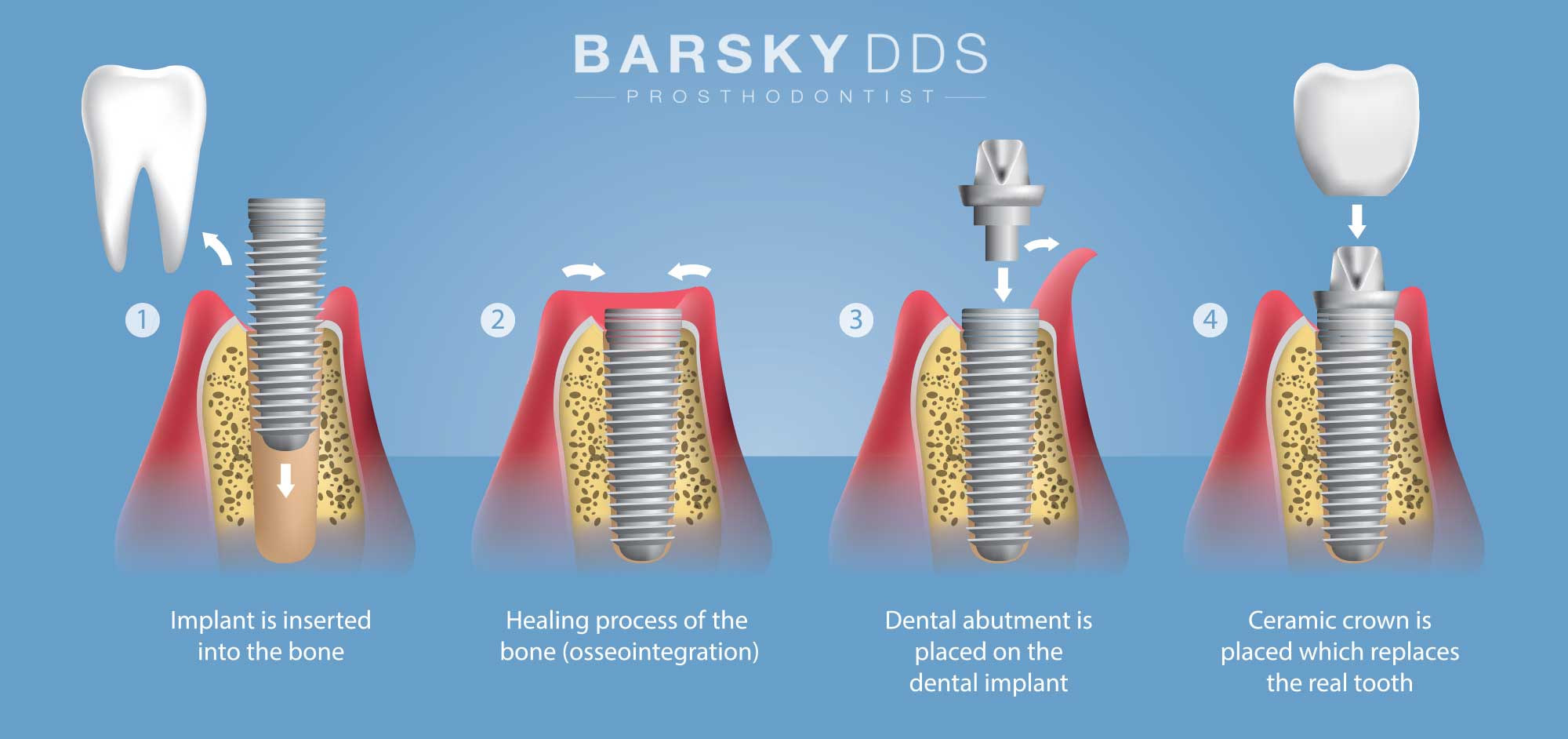 Как устанавливают имплант зуба пошагово с фото Tooth Crowns in South Miami with Dr. Todd B. Barsky Barsky DDS