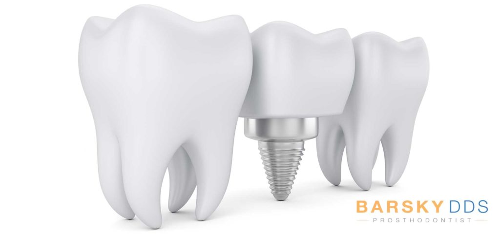 Tooth Crown on top of Dental Implant