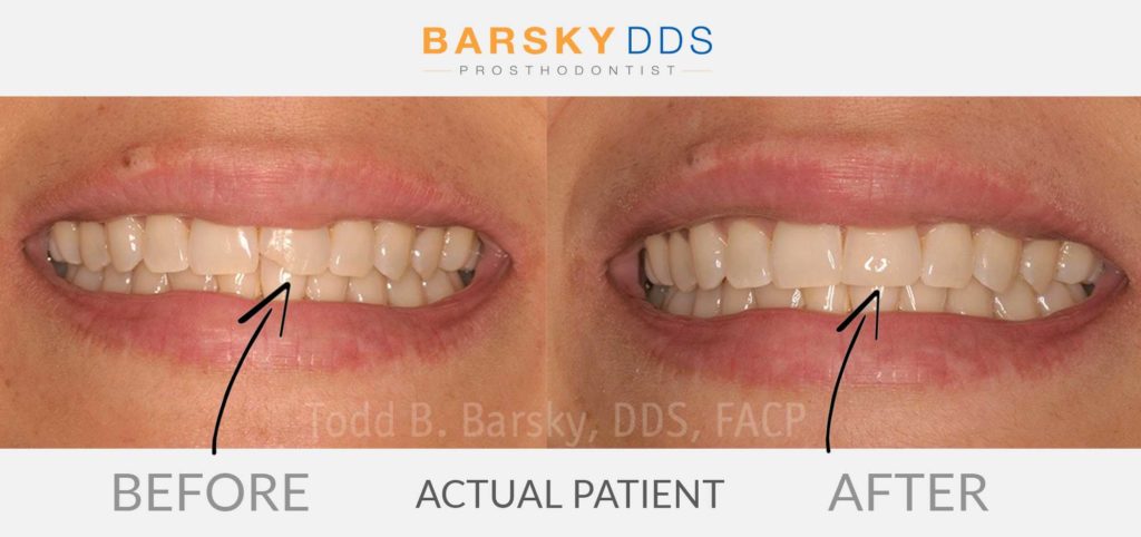 How to Fix a Chipped or Broken Tooth with Dr. Barsky in Miami