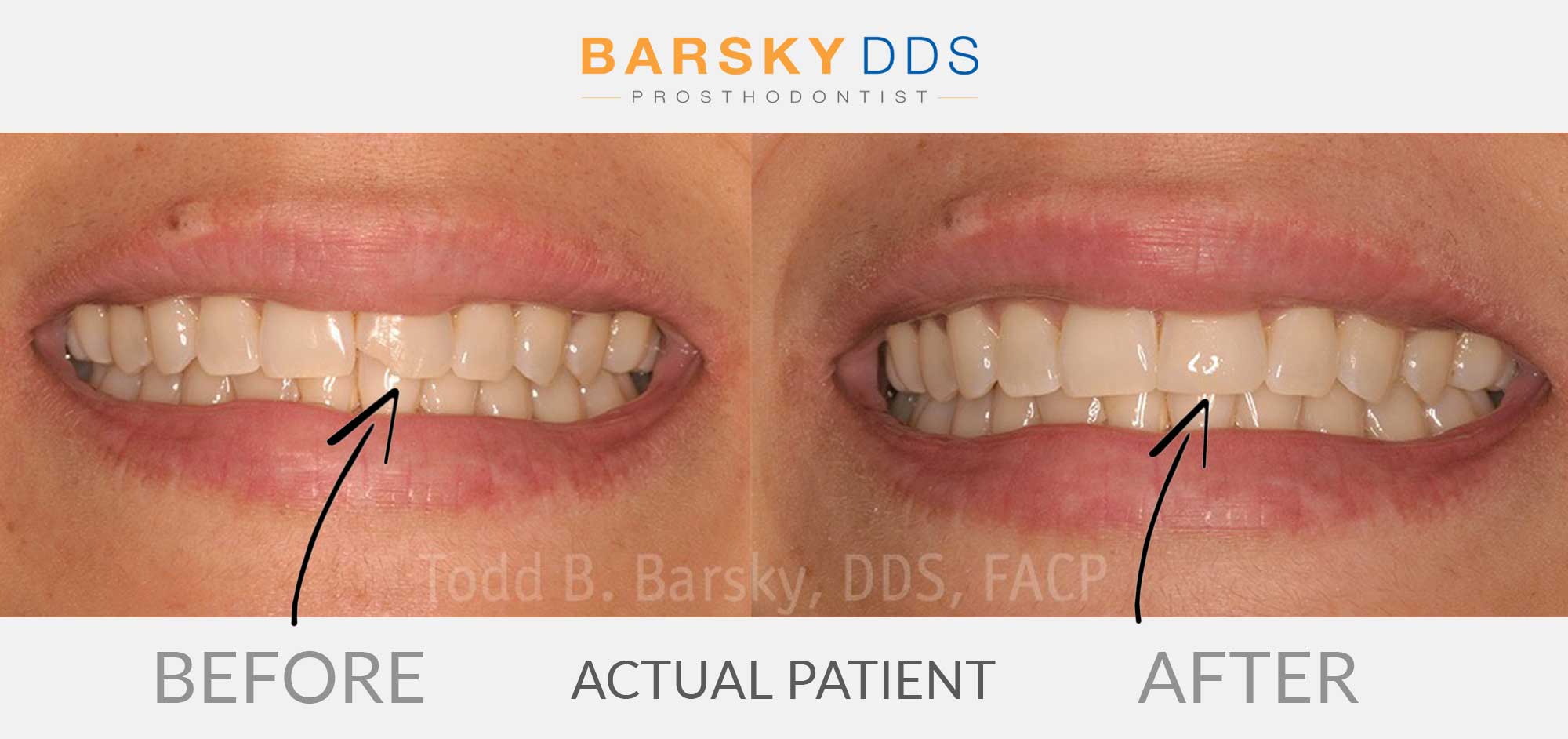 barsky dds fix broken tooth bonding